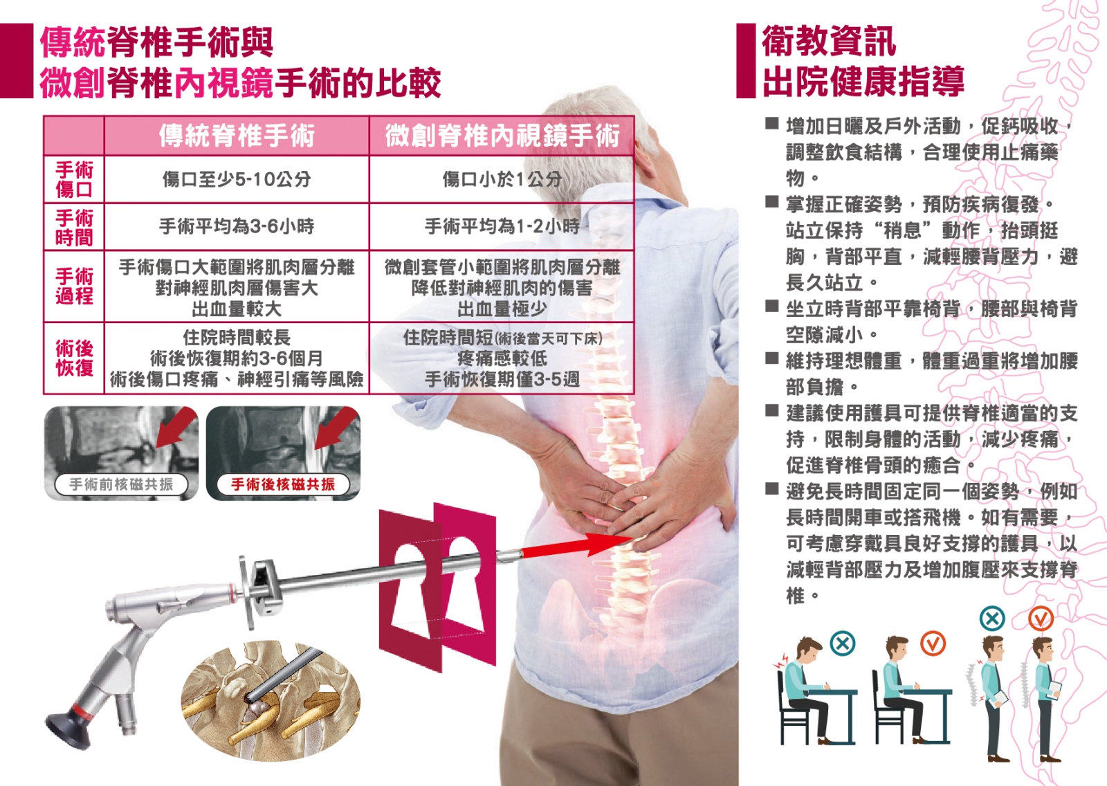 脊椎內視鏡手術介紹_微創脊椎手術_衛教專區| 活力得中山脊椎外科醫院